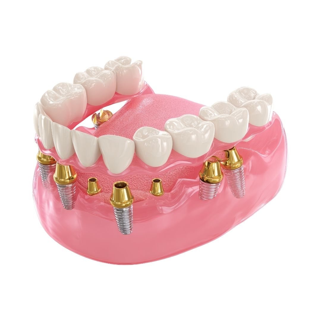 All-on-4 and All-on-6 full-arch implant prosthesis model for complete smile rehabilitation in Antalya