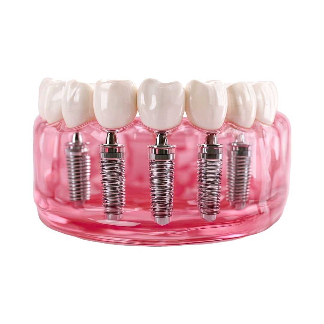 3D dental implant restoration model showing implant-supported crowns for missing teeth treatment in Turkey